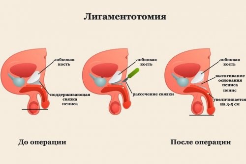Лигаментотомия
