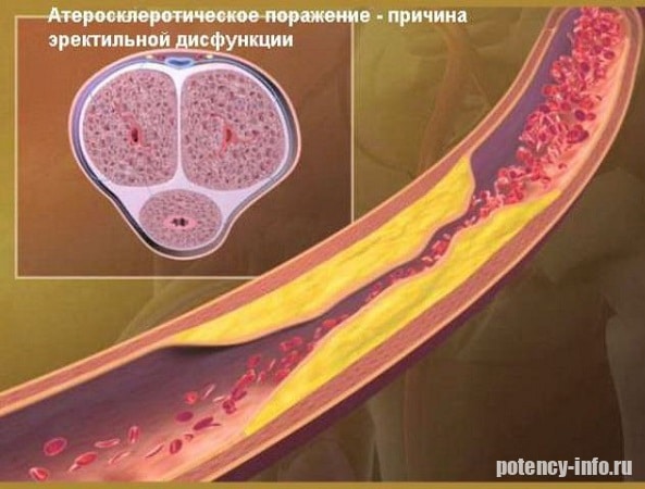 Влияние атеросклероза на потенцию