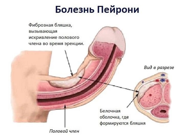 Болезнь Пейрони