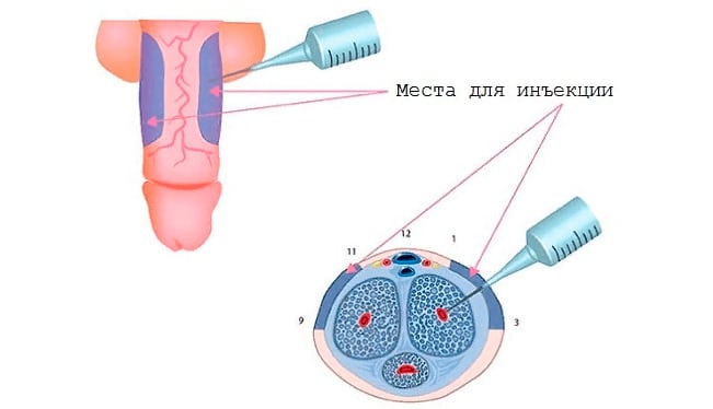 Места для введения гиалуроновой кислоты