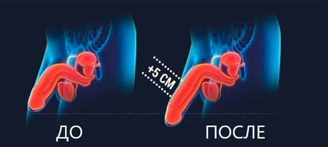 Увеличение члена гиалуроновой кислотой до и после